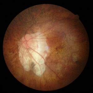 近視性脈絡膜新生血管　眼底写真